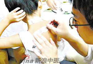 灸法的種類  你知道多少？